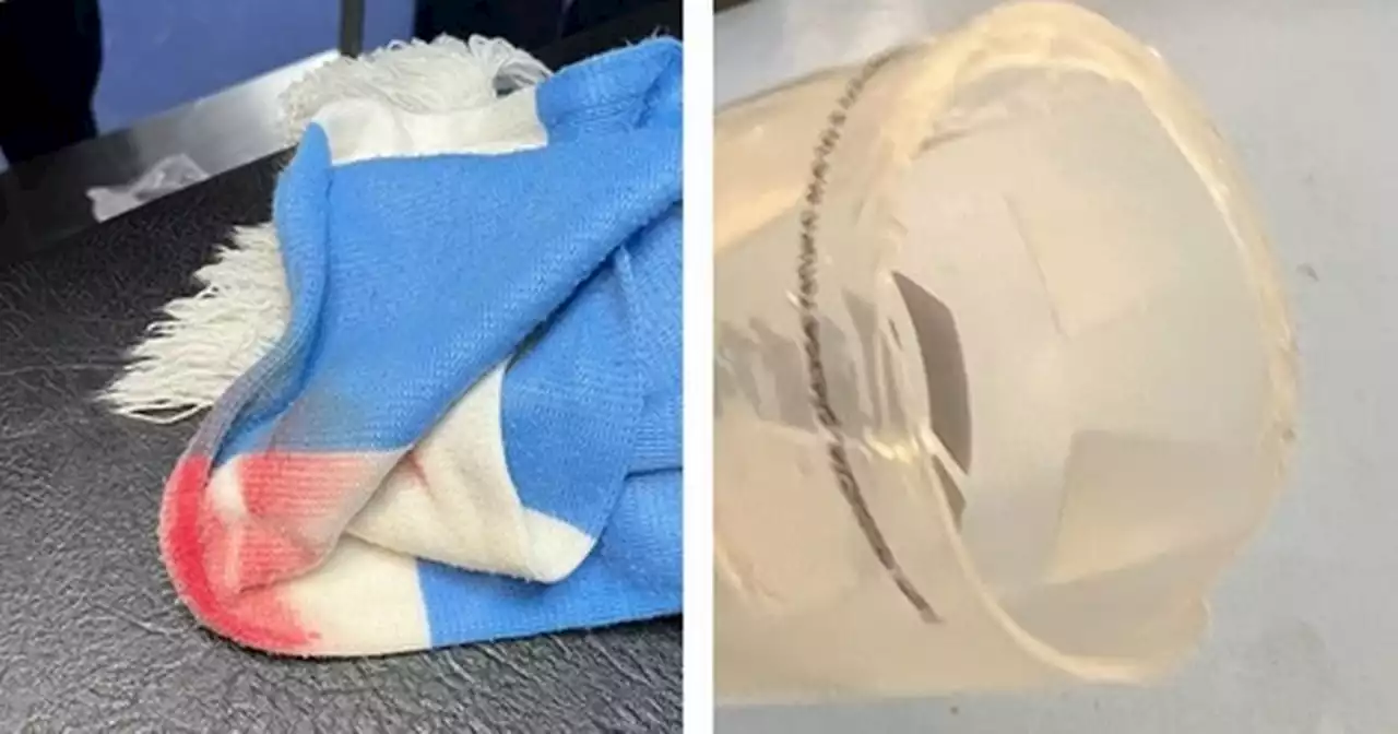 Girl hit by pint cup weighted with coins at Man City game is 'scarred for life'