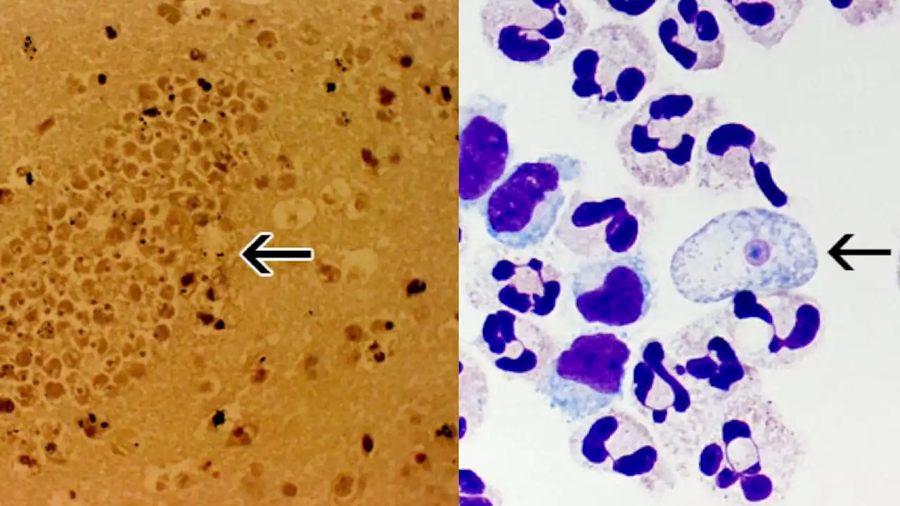 South Korean man dies due to 'brain-eating amoeba'