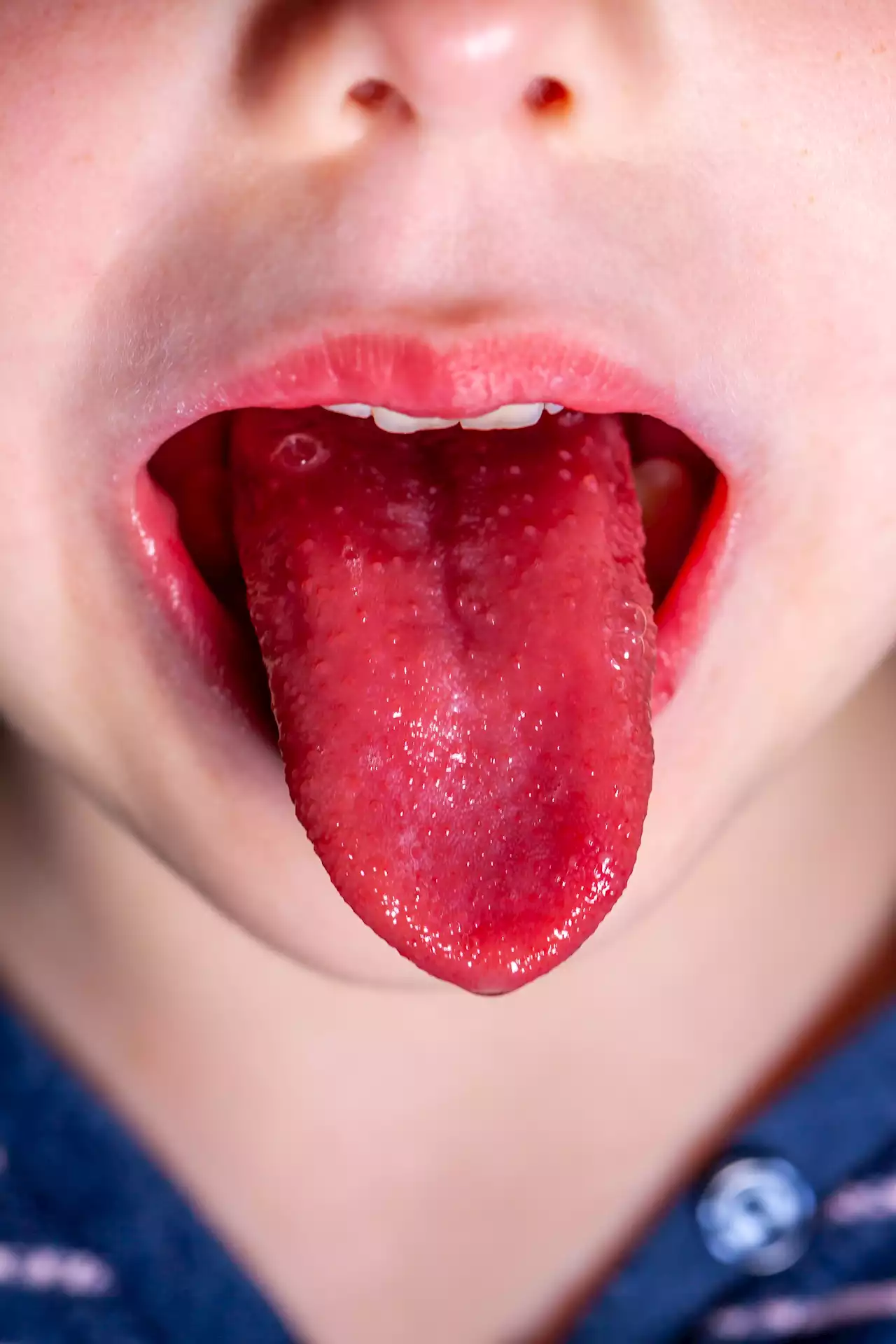 How to spot tell-tale scarlet fever rash as 6 kids die in Strep A outbreak