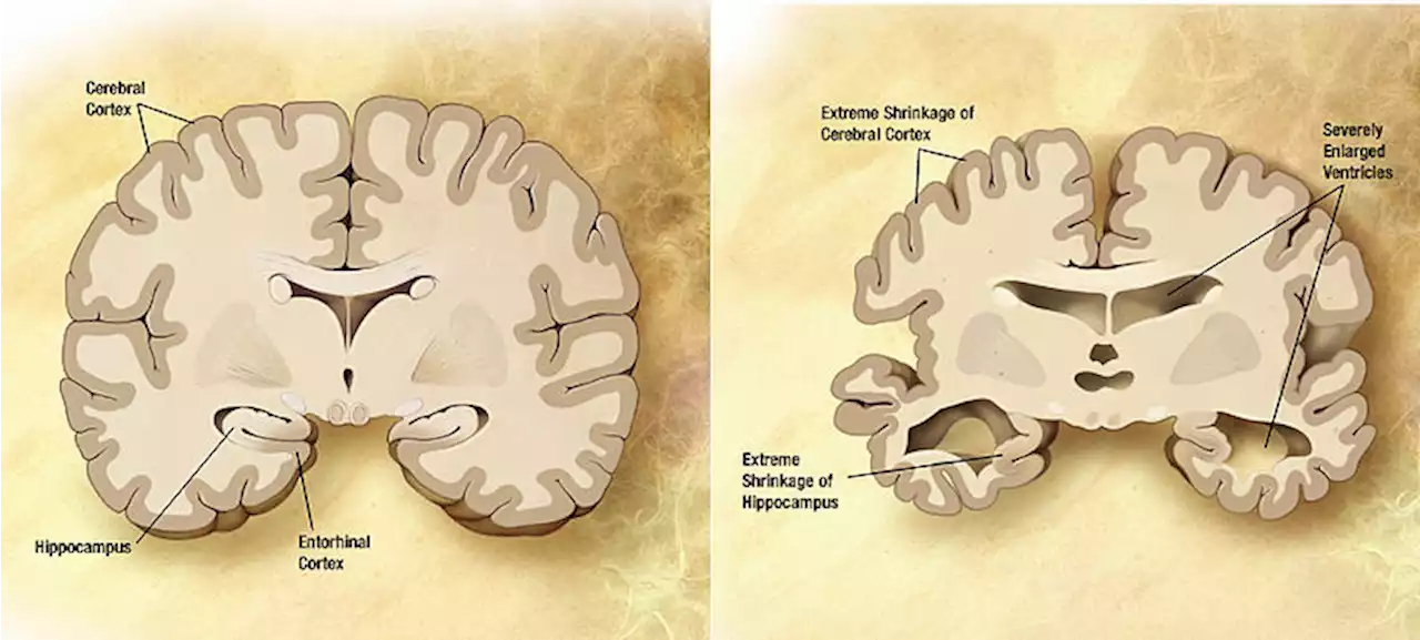 New blood test can detect 'toxic' protein years before Alzheimer's symptoms emerge, study shows