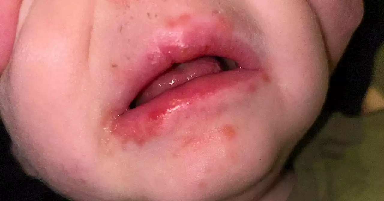 Mum's warning to parents after son's Strep A was mistaken for tonsillitis