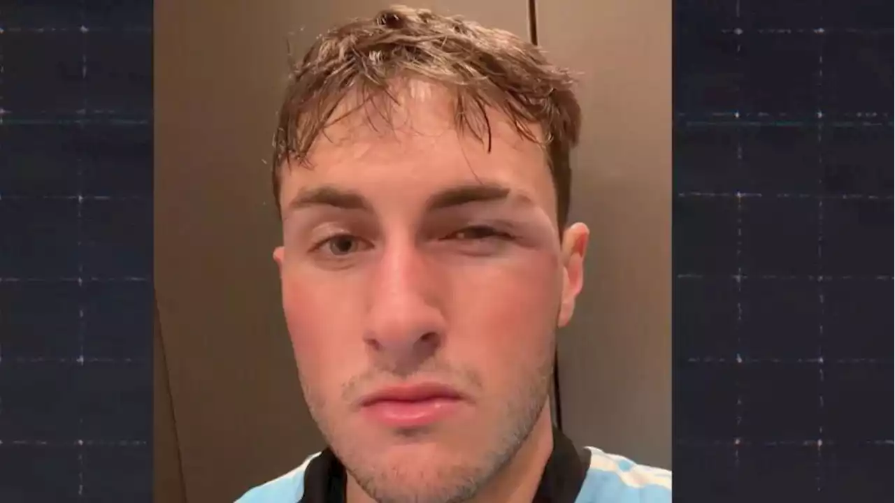 ¿Canelo? Giménez bromea sobre su ojo morado: 'Fue por defender a Messi'