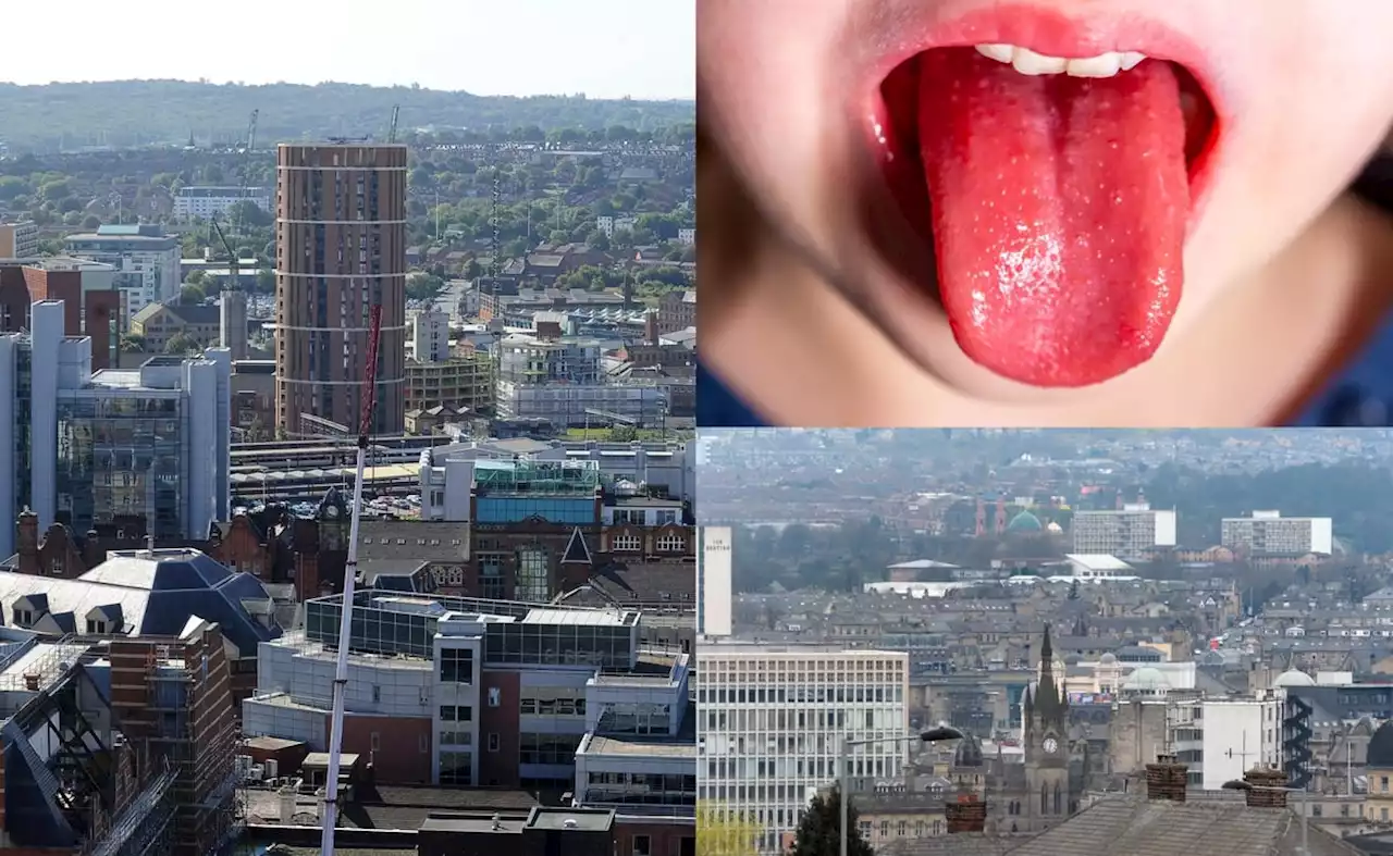 Every scarlet fever case in Yorkshire as Leeds records second highest number in England