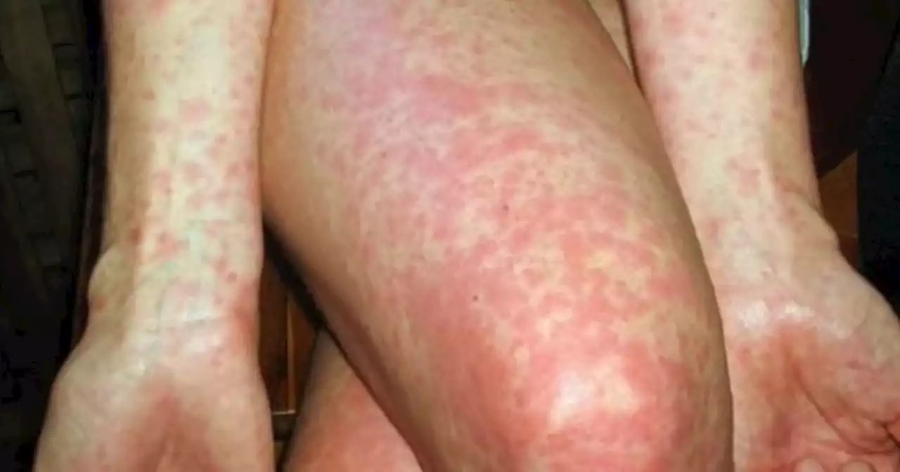 Scarlet fever outbreak at Lancs school as parents warned to be vigilant