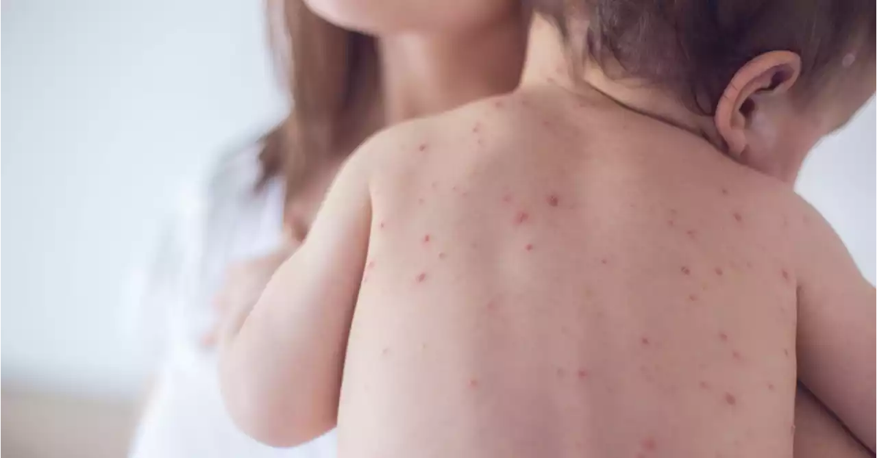 Ohio Measles Outbreak Sickens Nearly 60 Children