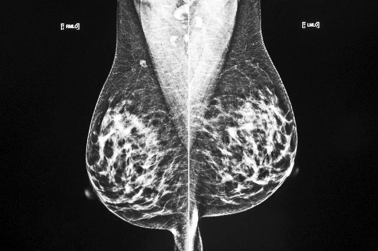 More breast cancer patients can choose smaller surgery