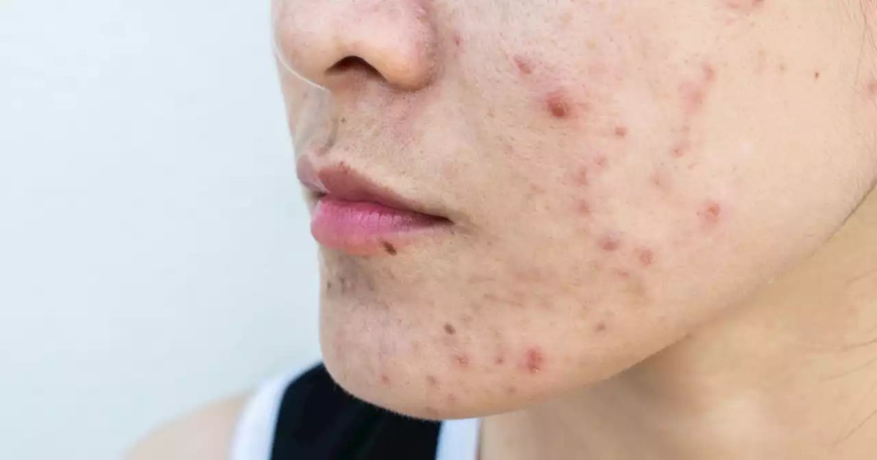 If You Have Acne, It’s Likely Not Because Of Anything You’re Doing Or Not Doing