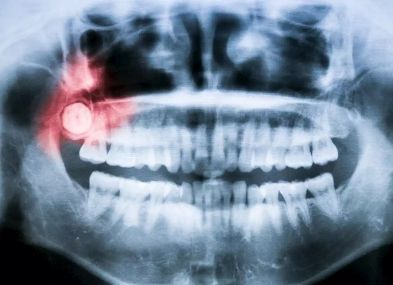 We finally know why we grow wisdom teeth as adults