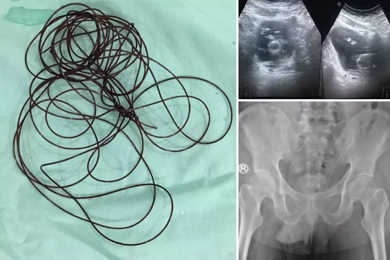 37-year-old virgin gets 6-foot string stuck in penis during botched sex game