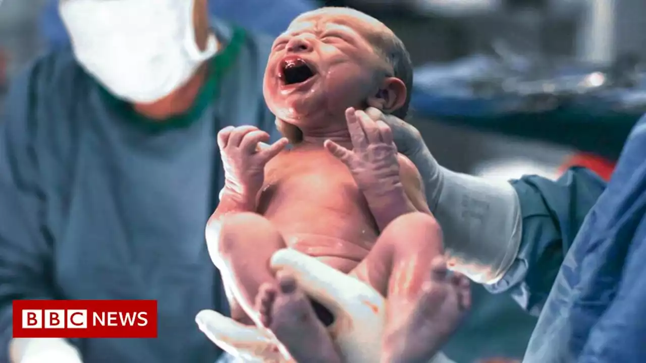 NHS England drops limit on offering Caesarean births