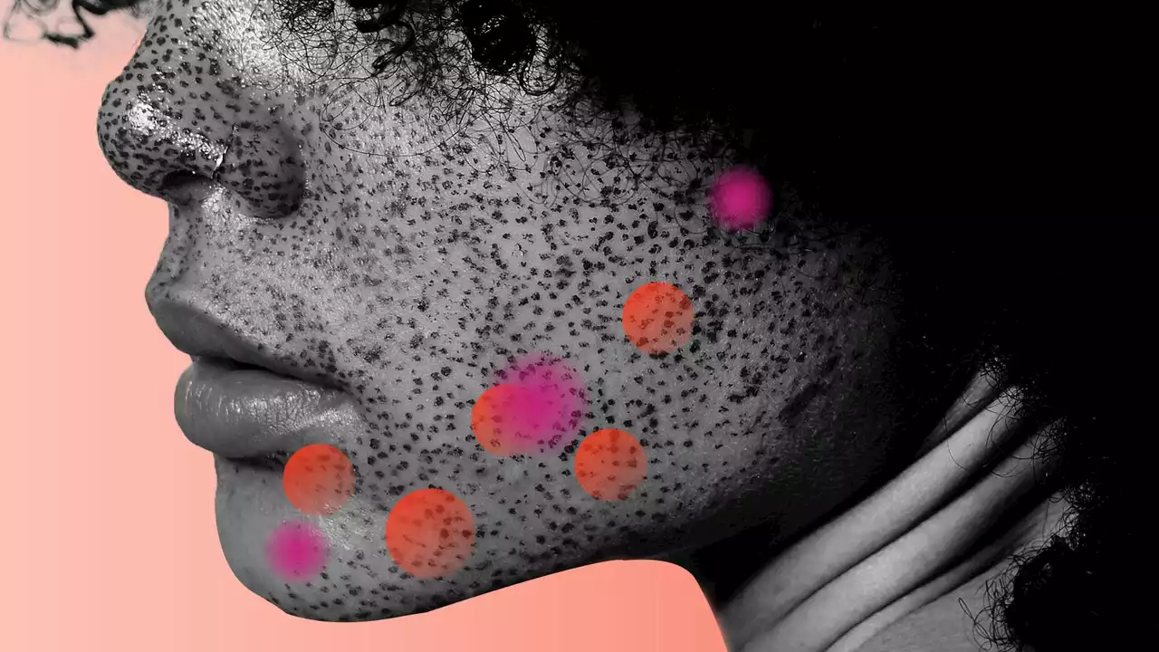 How to Get Rid of Cystic Acne Once and for All