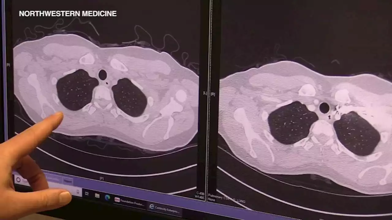 Can you get long COVID after an omicron infection? Many doctors believe it's possible