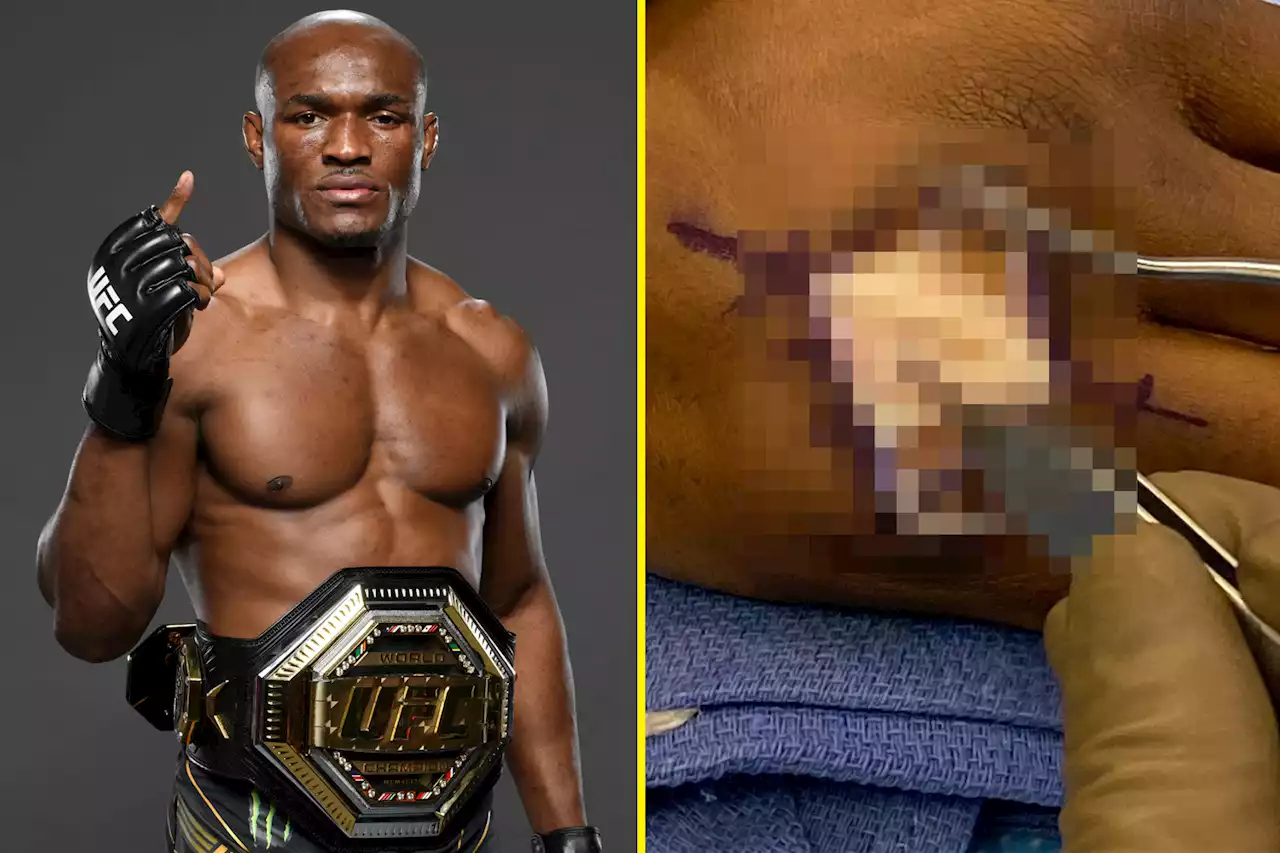 Dana White posts graphic pictures of Kamaru Usman's hand surgery