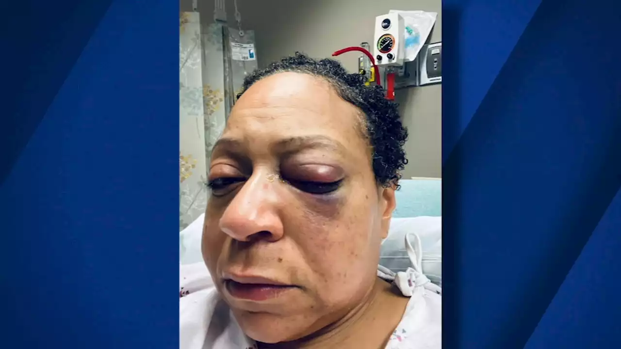 EXCLUSIVE: SF woman injured in unprovoked attack while celebrating a birthday at Ocean Beach