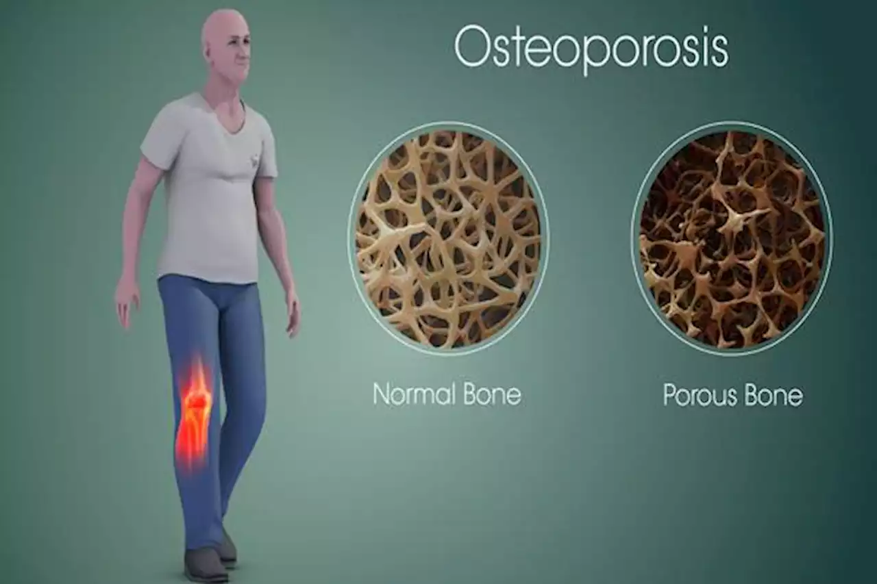 Ini Dia Suplemen Terbaik untuk Osteoporosis | Lifestyle - Bisnis.com