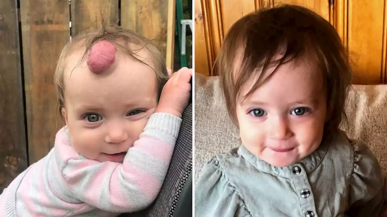 1-year-old girl gets blood-filled tumor removed from forehead