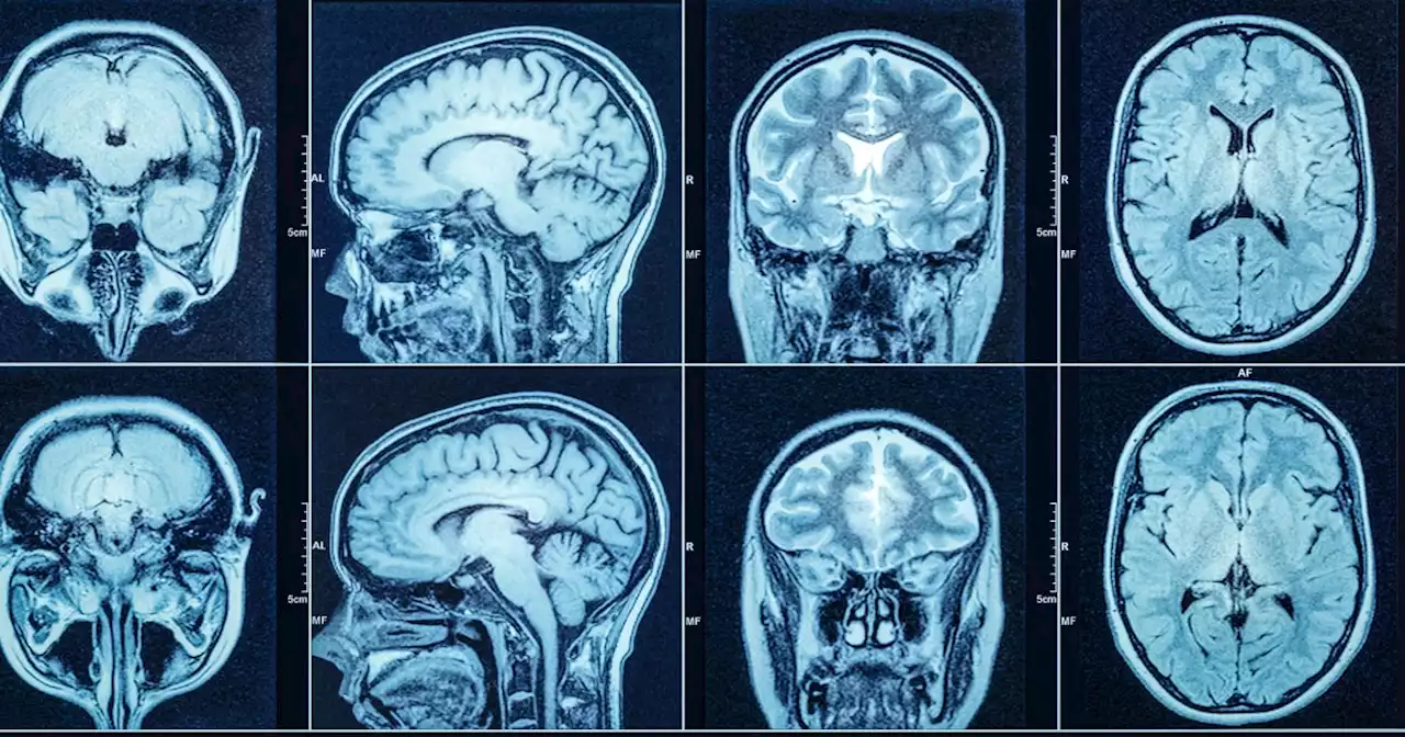 Even mild COVID-19 is linked to brain damage, scans show