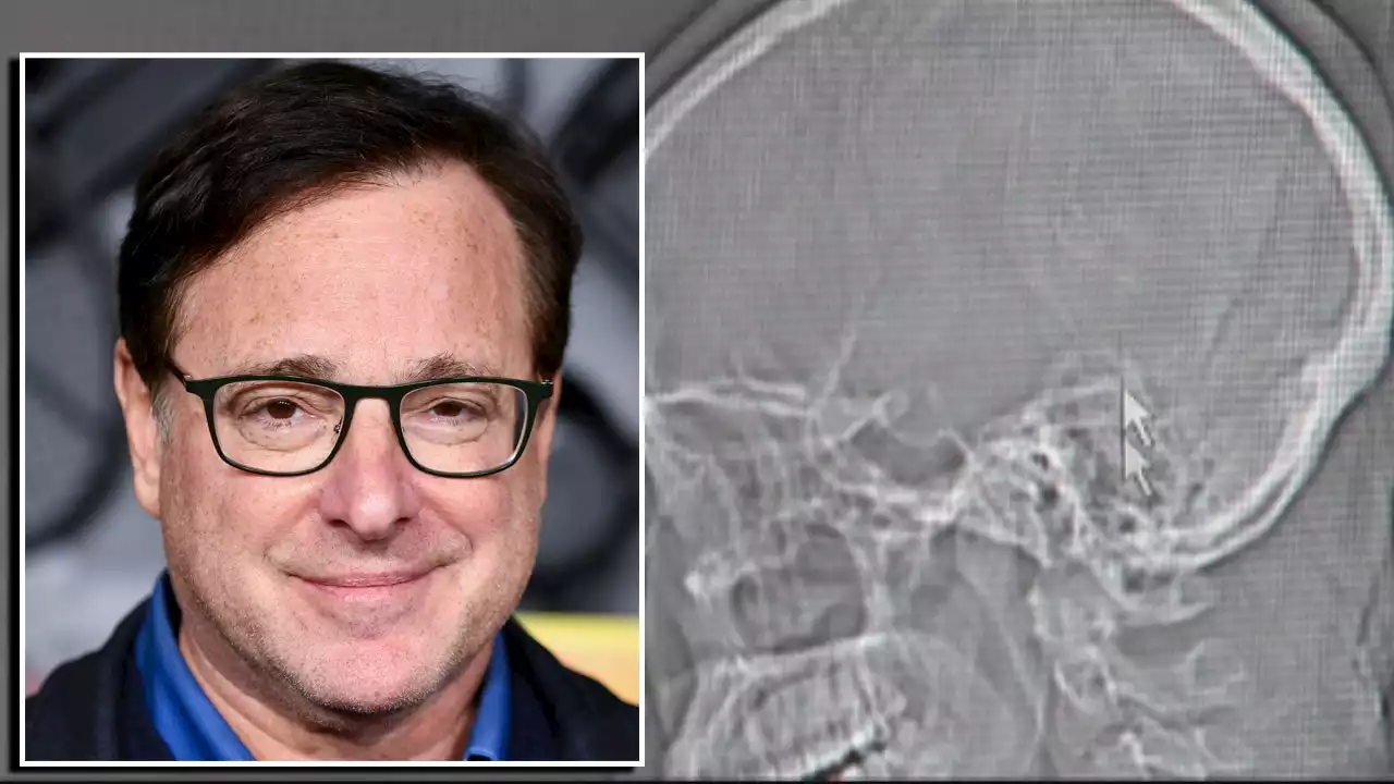 Bob Saget's fractures possibly caused by fall on carpeted floor