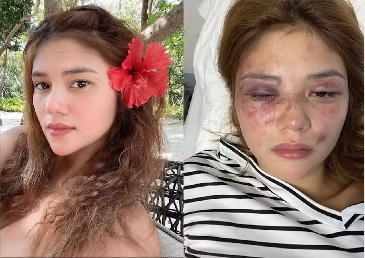 Ana Jalandoni posts bruised photo after Kit Thompson arrest