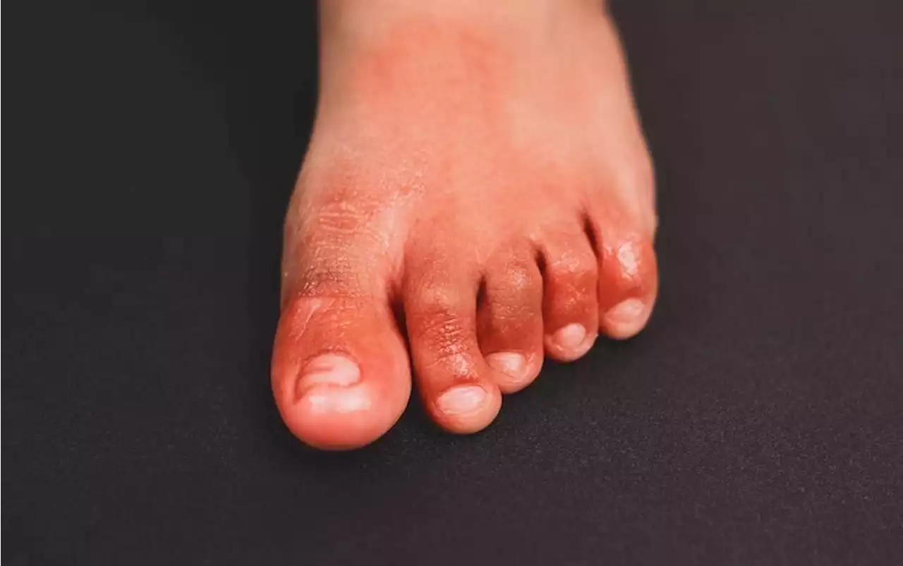 Are &lsquo;COVID Toes&rsquo; Actually Caused by the Coronavirus?