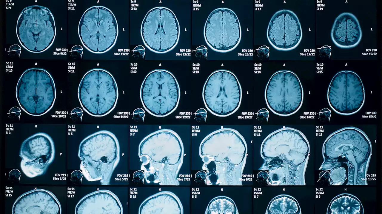 What do we mean by ‘COVID-19 changes your brain’?