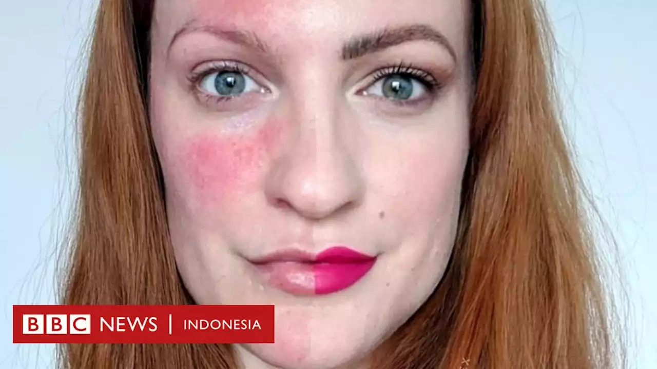 'Saat saya melihat kulit sendiri sebagai musuh ' - Pengidap rosacea berjuang mengatasi tekanan mental - BBC News Indonesia