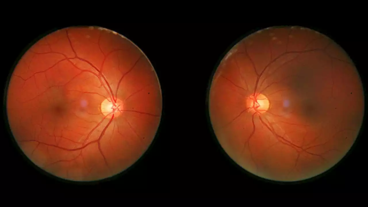 A drug once used to treat alcoholism may cure retinal degeneration