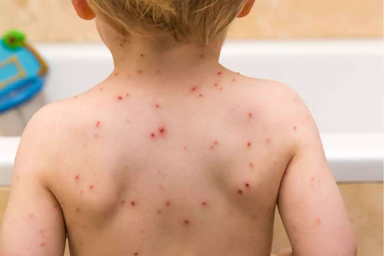 I'm a GP and here's the mistakes many parents make when it comes to chickenpox