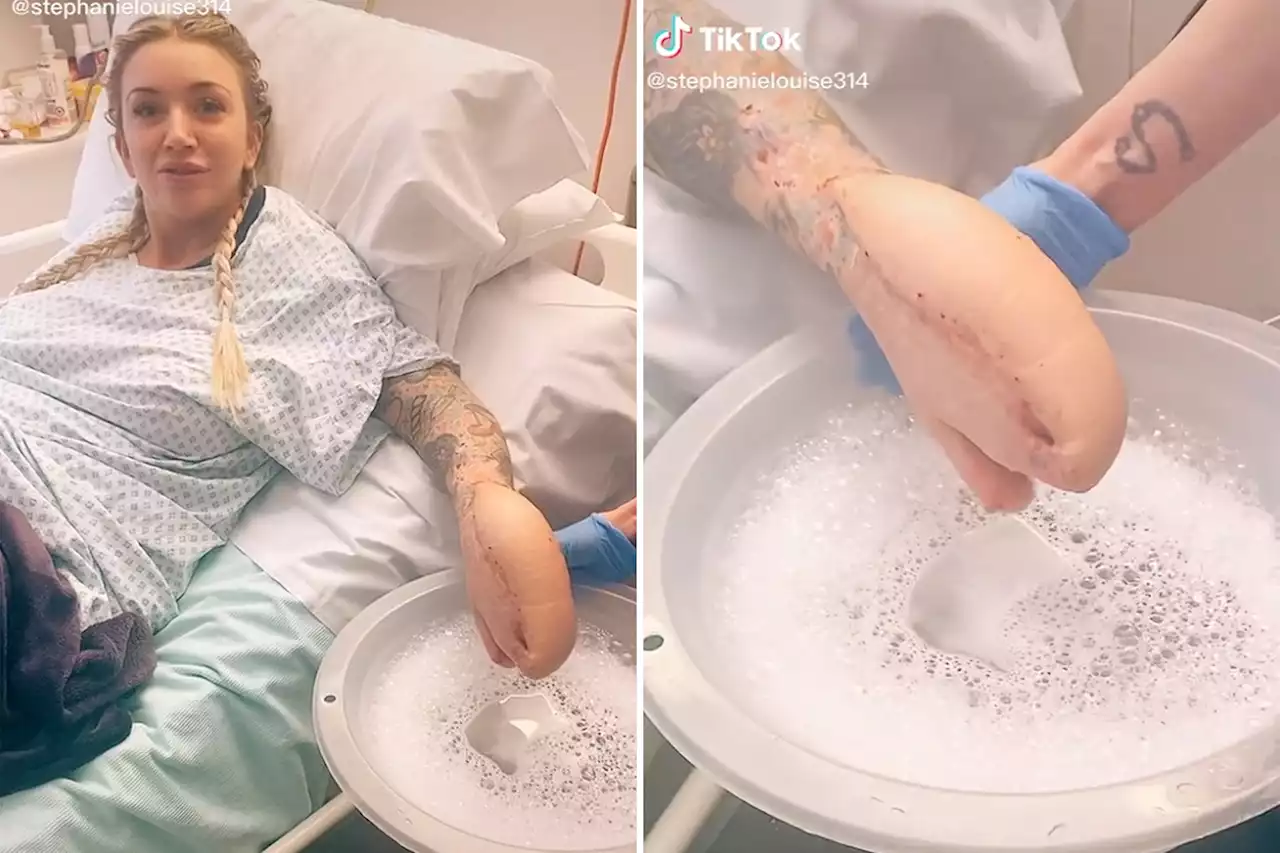 Woman left with ‘shark hand’ after doctors sew it inside stomach during surgery