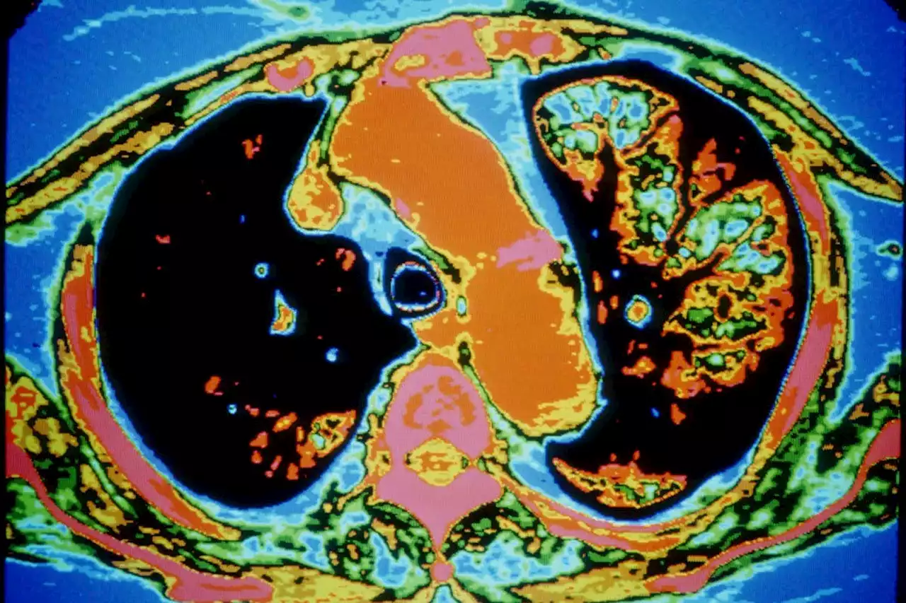 Drugs seem to help regenerate mouse lungs damaged by cigarette smoke