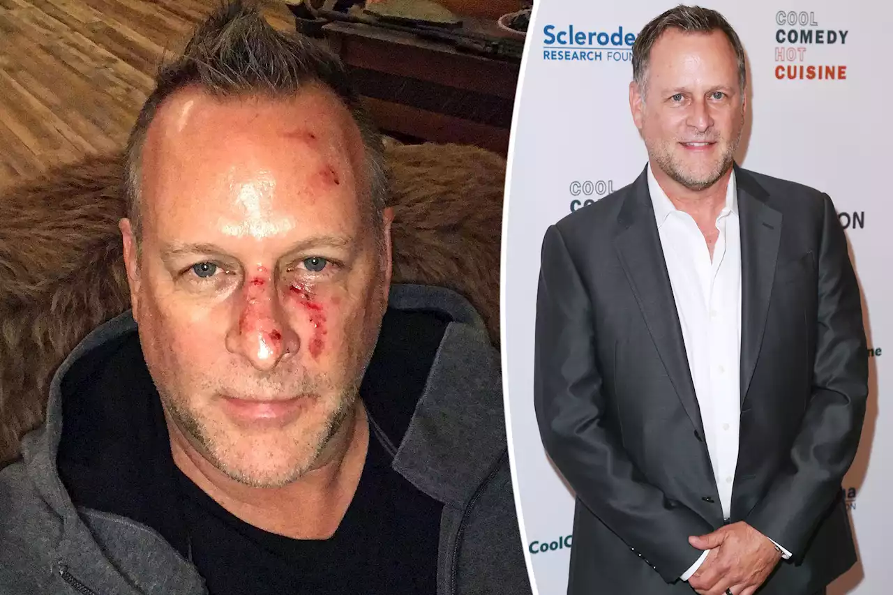 Dave Coulier celebrates two years sober with photo of ‘drunk’ injuries