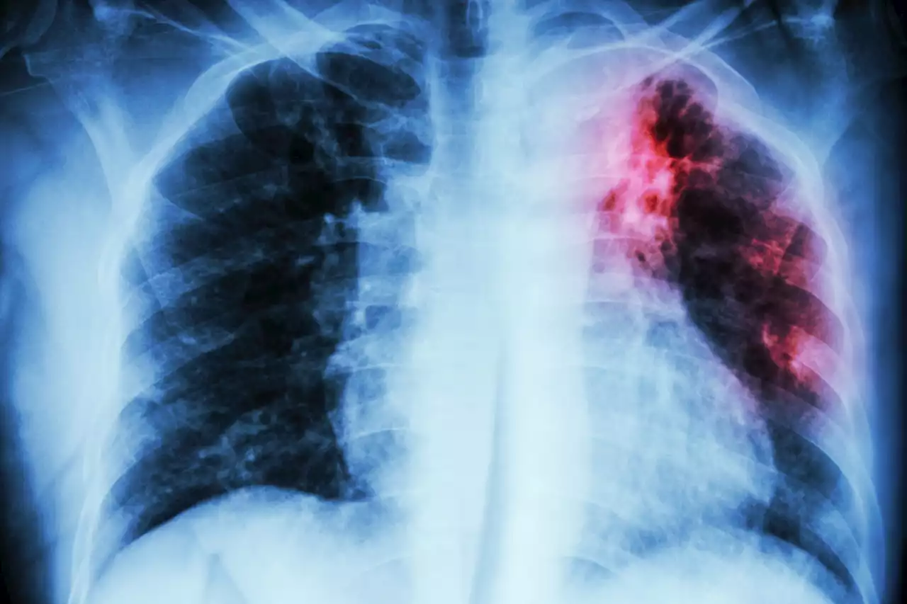 Calls for government to declare Tuberculosis a national health emergency