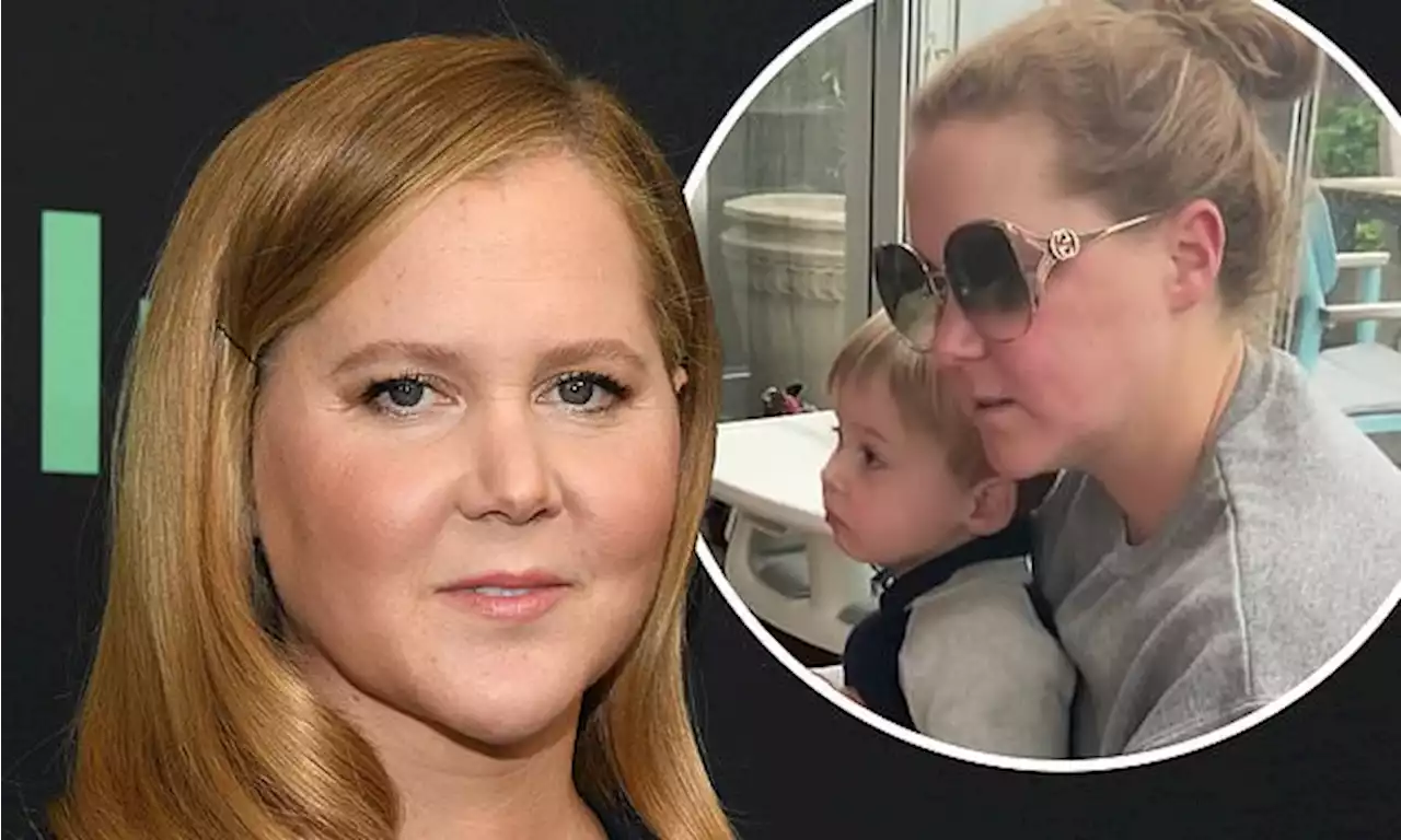 Amy Schumer gets candid on struggle with hair-pulling disorder