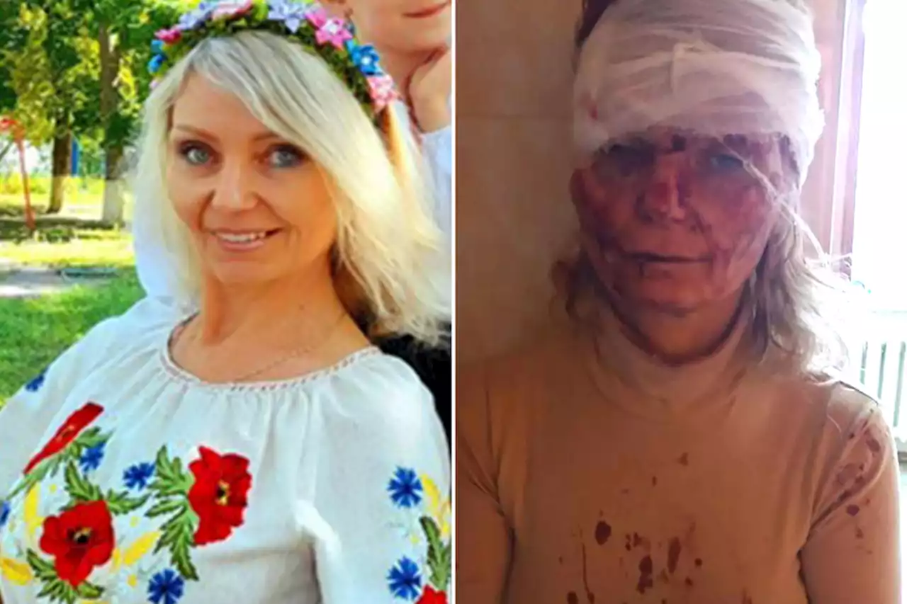 Ukraine teacher whose bloodied face went viral on the mend in Poland