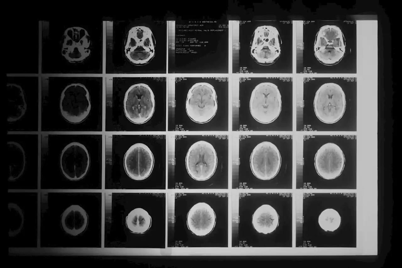 What do we mean by ‘COVID-19 changes your brain’?