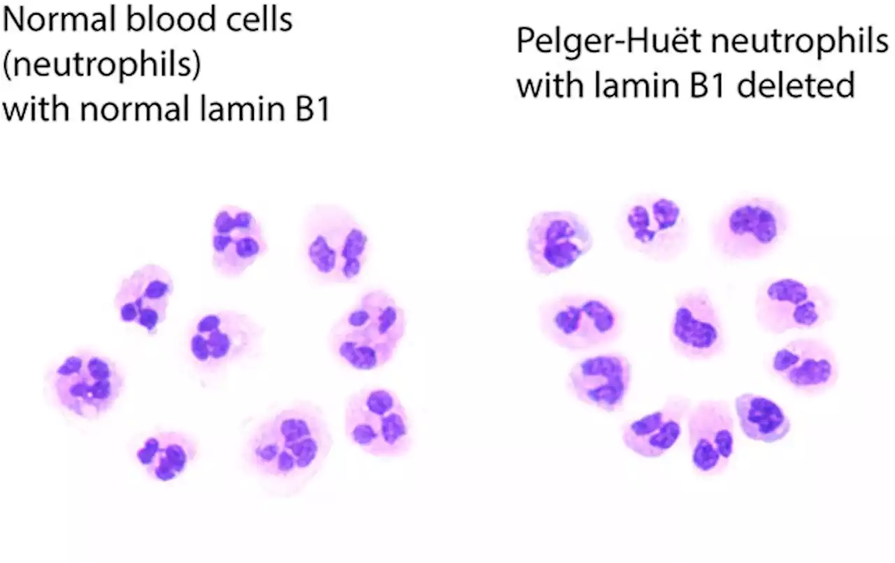 Gene deletion behind anomaly in blood cancer cells