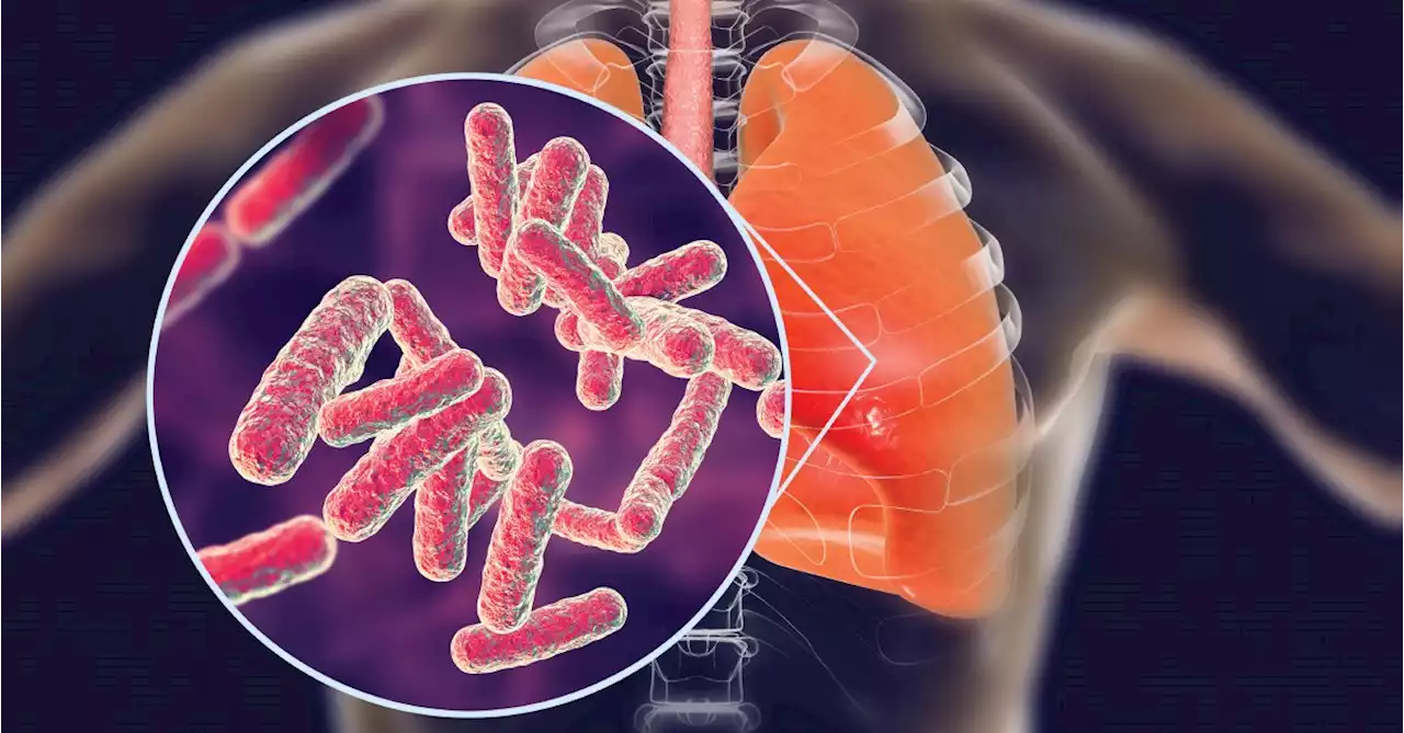 U.S. Tuberculosis Rates Up More Than 9% In 2021