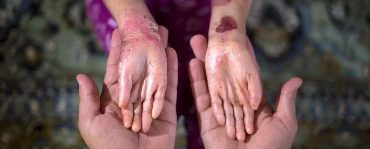 Amazing Gel Finally Brings Healing to People With 'Butterfly Children' Disease