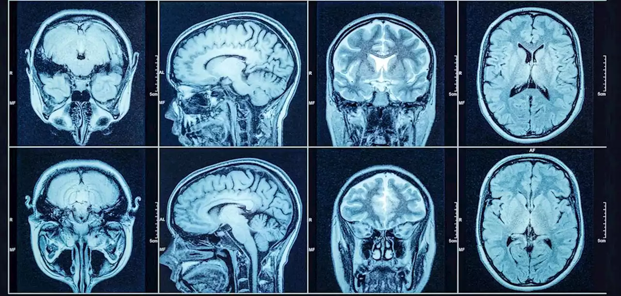 Even mild COVID-19 is linked to brain damage, scans show