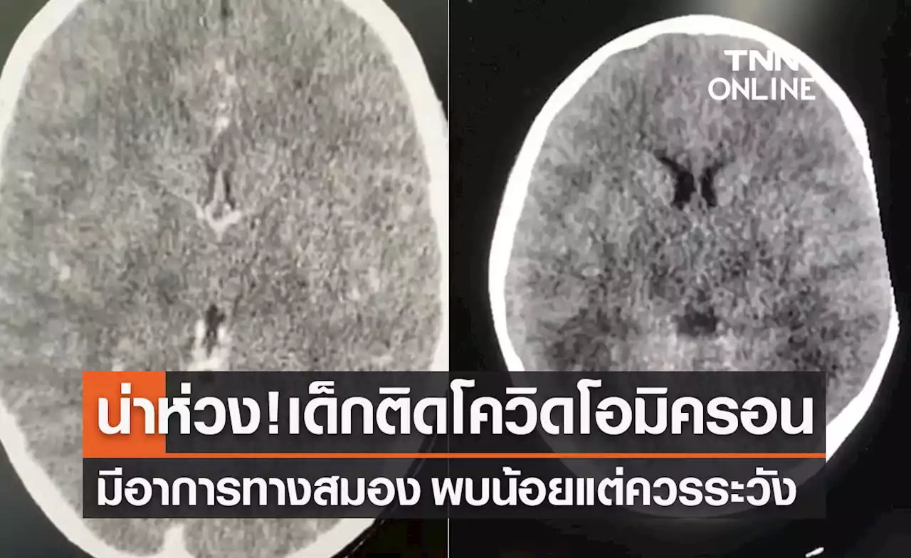 แพทย์เผย 'โอมิครอน' น่าห่วงพบเด็กติดเชื้อมีอาการทางสมองรุนแรง