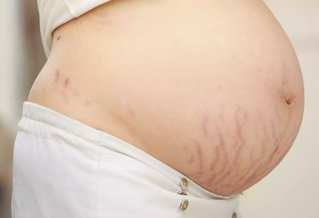 Stretch marks in pregnancy: why they appear and what can you do about them?