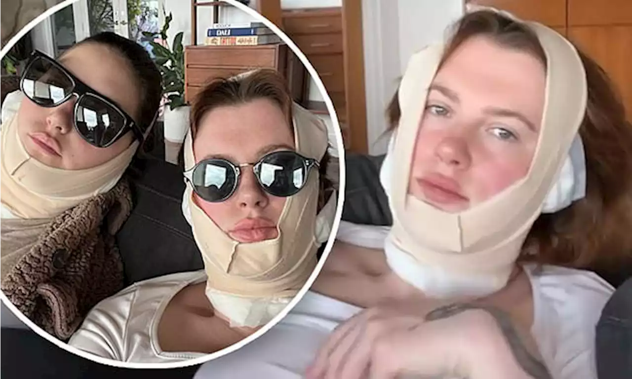 Ireland Baldwin, 26, recovers from 'mini facelift' at plastic surgeon