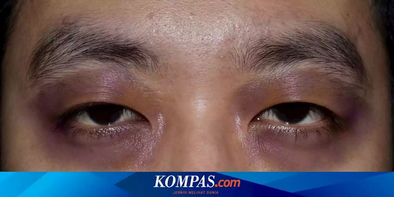 Mengenal Raccoon Eye, Kondisi Memar di Sekitar Kedua Mata