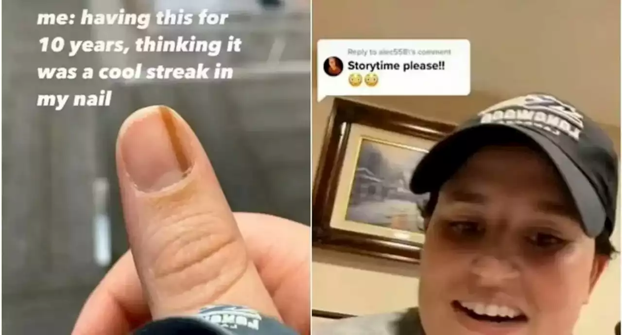 Joven mostró en TikTok que mancha “cool” en su uña resultó ser cáncer - Pulzo