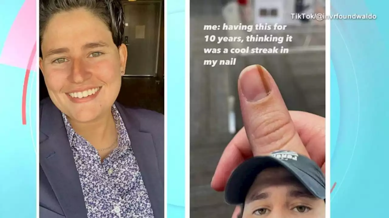 Woman shares warning on TikTok after nail streak was more than a mole