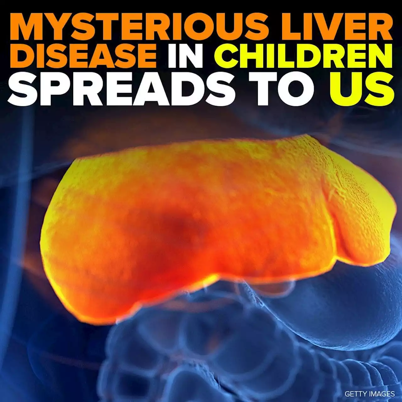 Mysterious liver disease in children spreads to US, Europe