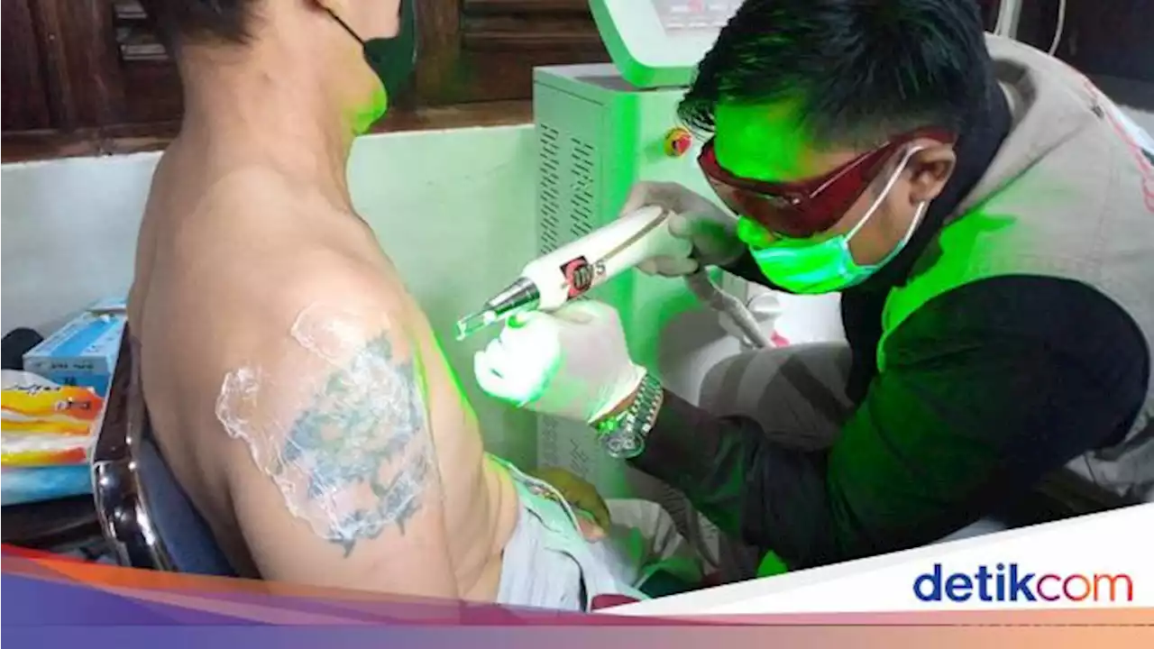 Tak Bisa Instan, Begini Cara Kerja Hapus Tato Pakai Laser