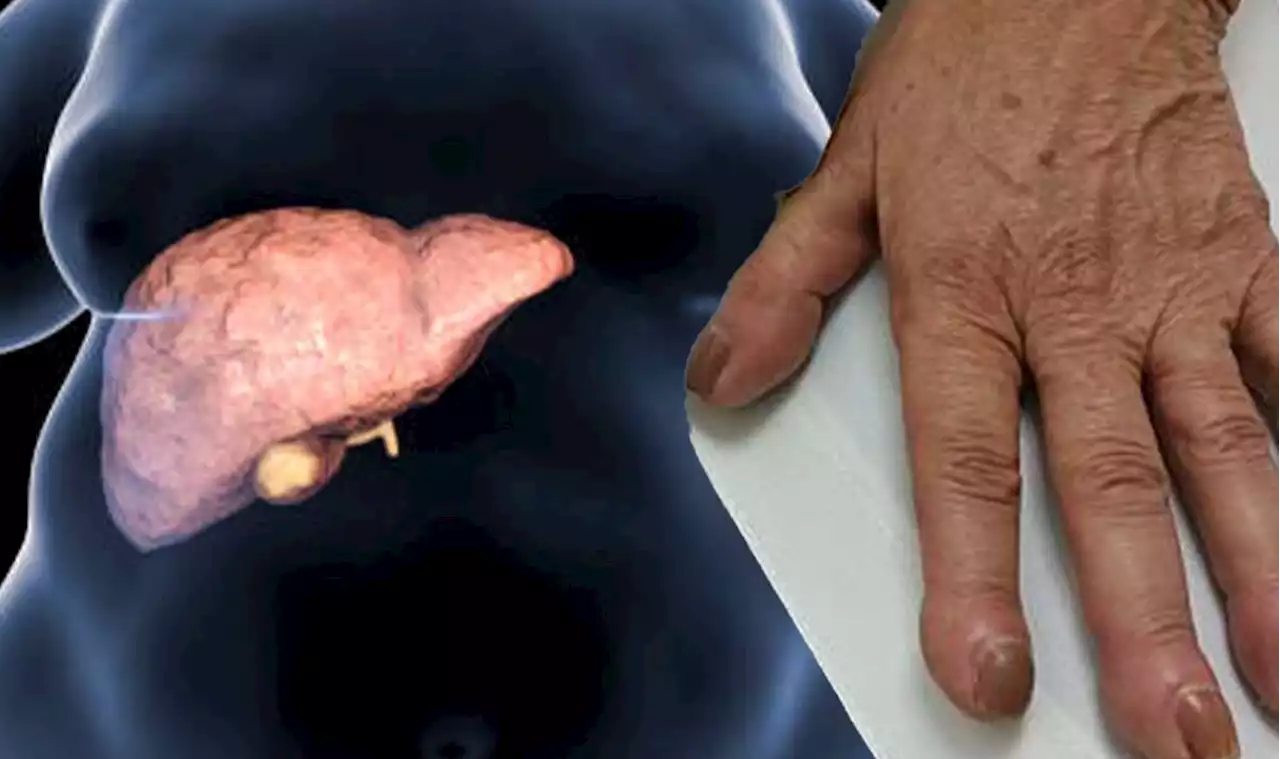 Fatty liver disease: The ends of fingers becoming wider can signal the liver is struggling