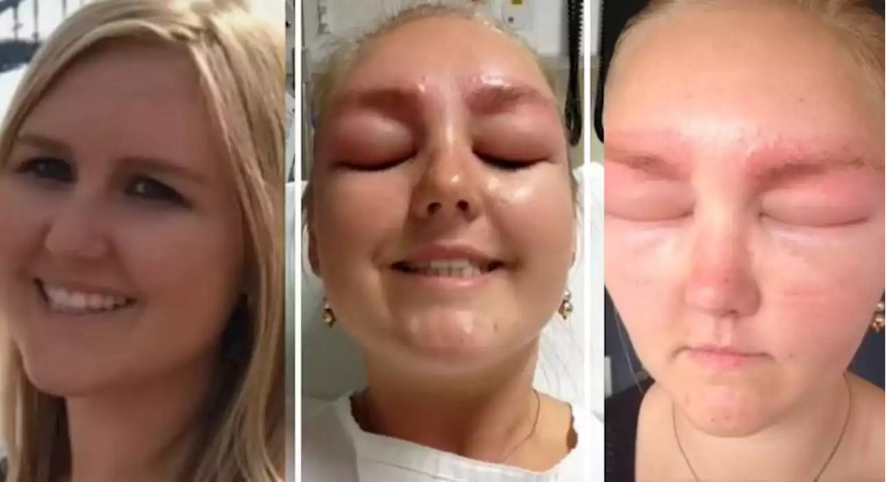 Noiva fica com cara de 'alien' após alergia a procedimento estético