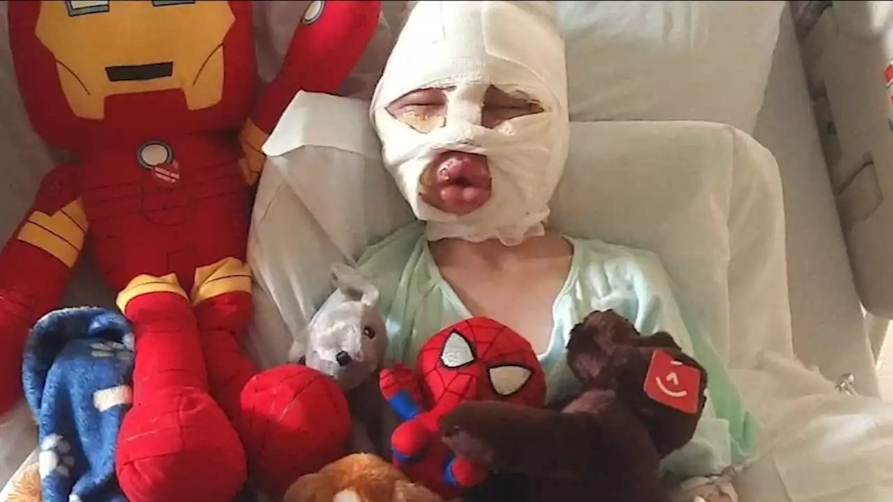 6-year-old Connecticut boy brutally burned, mother says he was bullied